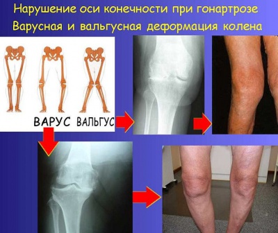 Описание: Поражение коленных суставов при остеоартрозе