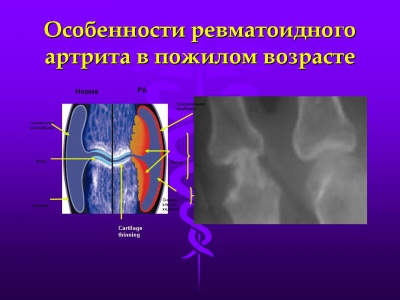Описание: Особенности ревматоидного артрита в пожилом возрасте